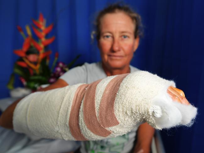 Professional  fisherwoman Juanita Davey pictured at Royal Darwin Hospital after her battle with a 3.7m bull shark. Picture: Keri Megelus