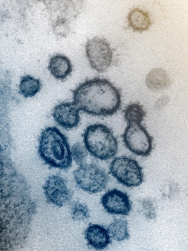 A sample of the novel coronavirus SARS-CoV-2 isolated from a patient in the US.