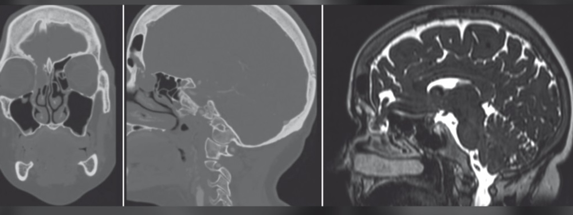 A COVID-19 nasal swab test caused brain fluid to leak from woman’s nose. Picture: JAMA Otolaryngology/University of Iowa Hospitals and Clinics