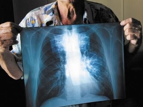 BLACK LUNG: Percy Verrall was diagnosed with black lung disease in 2015. He was the first Australian diagnosed with the disease in 30 years.