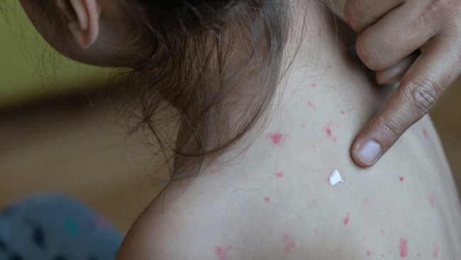 Is it chicken pox or measles?
