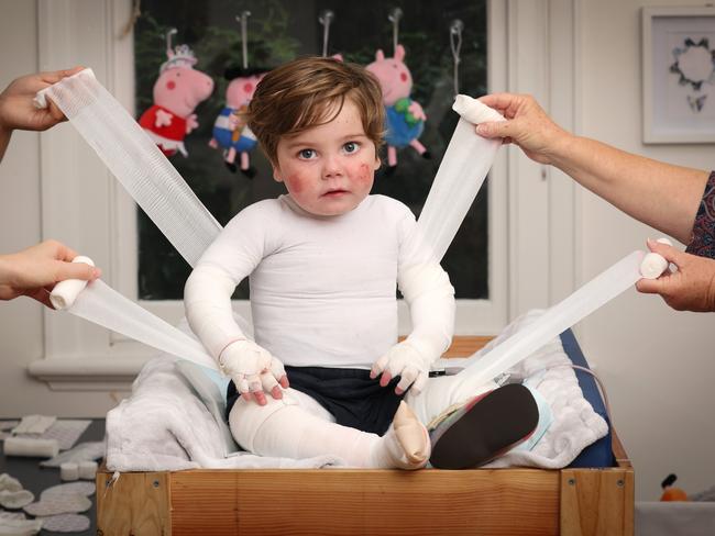 WARNING HOLD FOR Good Friday Appeal 2024 at the RCH. Jacob Burmeister 2, Butterfly Boy. Jacob has  Recessive Dystrophic Epidermolysis Bullosa whole body is bandaged to prevent blisters and wounds. Jacob endures a daily full body bandage change, skin check and wound dressing that can take more than 2 hours.                   Picture: David Caird