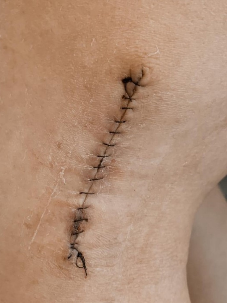 She needed 18 stitches after it was removed. Picture: Instagram