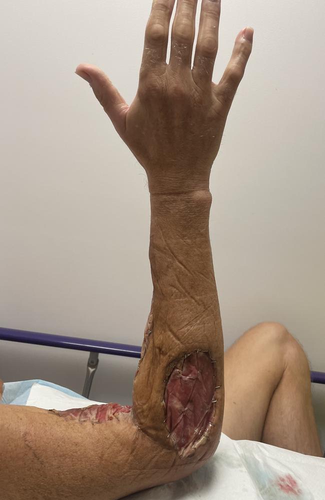 Andrew Emmerig, of Brisbane, nearly loses arm to ocean bacteria while holidaying on Sunshine Coast. Picture – contributed.