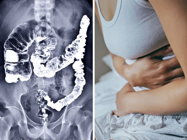 Woman, 44, with stage 3 bowel cancer reveals symptoms she ‘ignored’. Picture: iStock