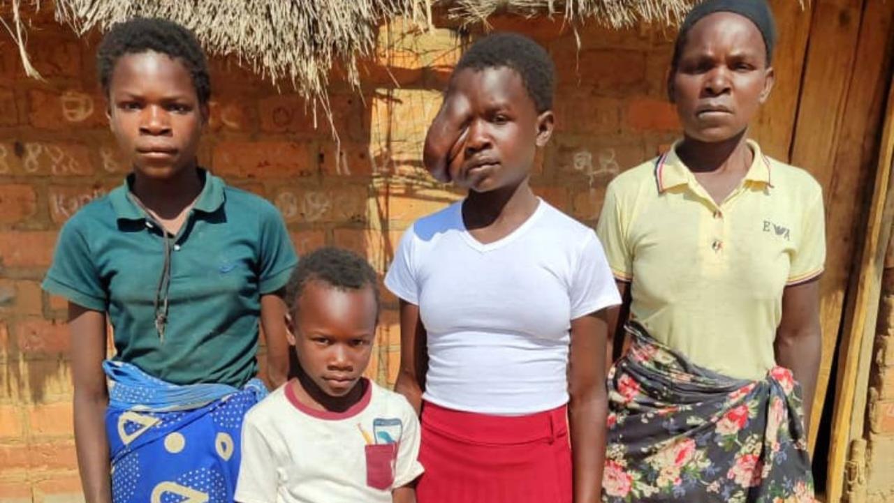 Australian-based charity Children First Foundation brought Elinah, seen here with family members, from Zambia to Adelaide for craniofacial surgery at the Women’s and Children’s Hospital.