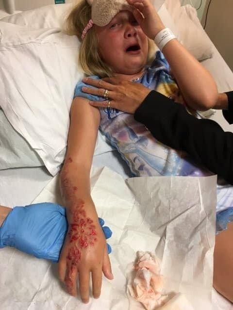 STEER CLEAR: A young girl suffered from a painful skin reaction after getting a temporary henna tattoo while overseas. Picture: CONTRIBUTED