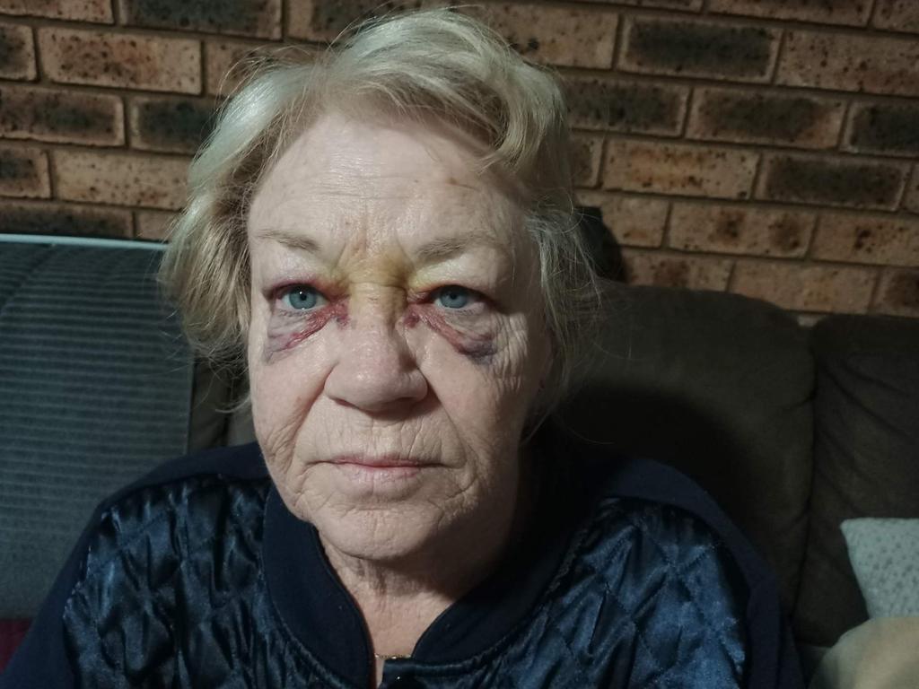 Ms Smith sustained two black eyes in the assault. Picture: Supplied