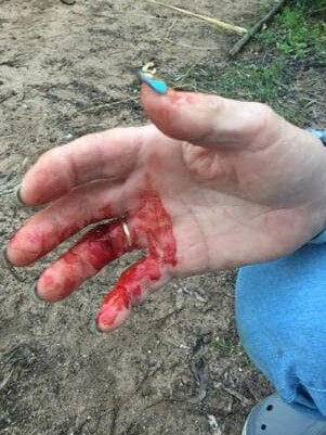 Kim's bloody fingers after the wombat attack on her family.