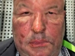 Former NSW Police minister David Elliott after he suffered burns from a gas explosion. Picture: 2GB