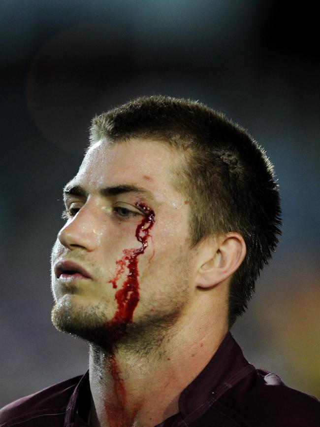 Foran leaves the field bloodied.