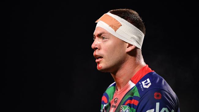 Rocco Berry shows the scars of the battle during the Warriors’ win. (Photo by Kai Schwoerer/Getty Images)