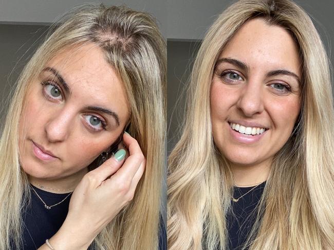 She started experiencing hair loss at 19. Picture: Supplied/Lusta Hair