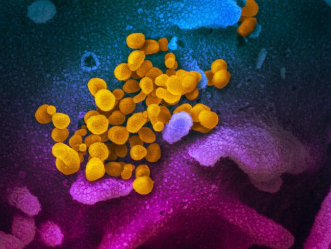 TOPSHOT - This handout illustration image obtained February 27, 2020 courtesy of the National Institutes of Health taken with a scanning electron microscope  shows SARS-CoV-2 (yellow)—also known as 2019-nCoV, the virus that causes COVID-19—isolated from a patient in the US, emerging from the surface of cells (blue/pink) cultured in the lab. - President Donald Trump has played down fears of a major coronavirus outbreak in the United States, even as infections ricochet around the world, prompting a ban on pilgrims to Saudi Arabia. China is no longer the only breeding ground for the deadly virus as countries fret over possible contagion coming from other hotbeds of infection, including Iran, South Korea and Italy. There are now more daily cases being recorded outside China than inside the country, where the virus first emerged in December, according to the World Health Organization. (Photo by Handout / National Institutes of Health / AFP) / RESTRICTED TO EDITORIAL USE - MANDATORY CREDIT "AFP PHOTO /NATIONAL INSTITUTES OF HEALTH/NIAID-RML/HANDOUT " - NO MARKETING - NO ADVERTISING CAMPAIGNS - DISTRIBUTED AS A SERVICE TO CLIENTS