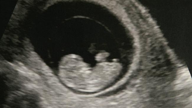 Happier times; an ultrasound photo of a healthy baby Zoe inside it’s mother Brodie Donegan before she was hit by a car on Christmas Day in 2009.