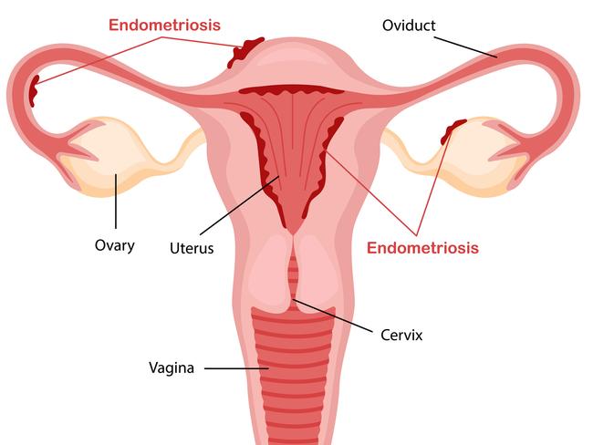 A diagram of endometriosis. Picture: istock