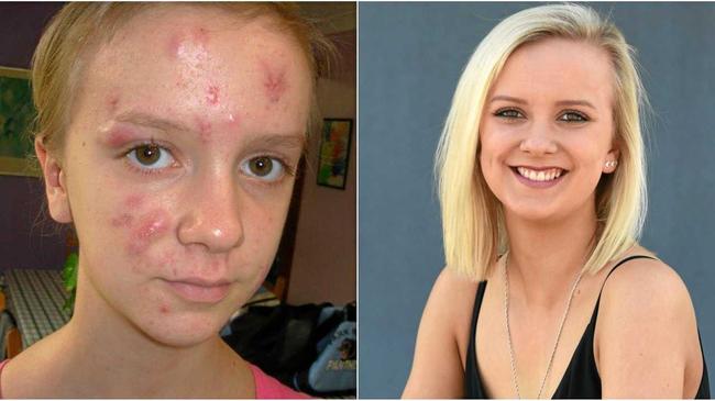 Fraser Coast Chronicle journalist Inge Hansen suffered from cystic acne in her early teens and was bullied as a result. Picture: Inge Hansen