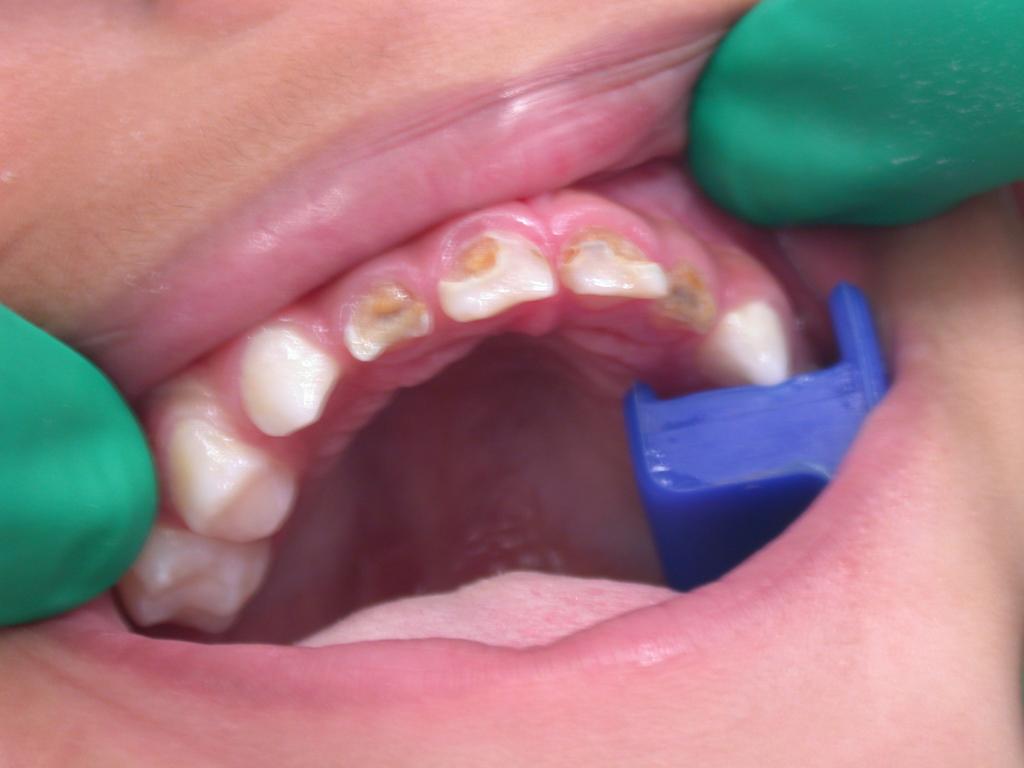 Tooth decay is linked to a litany of other serious health conditions.