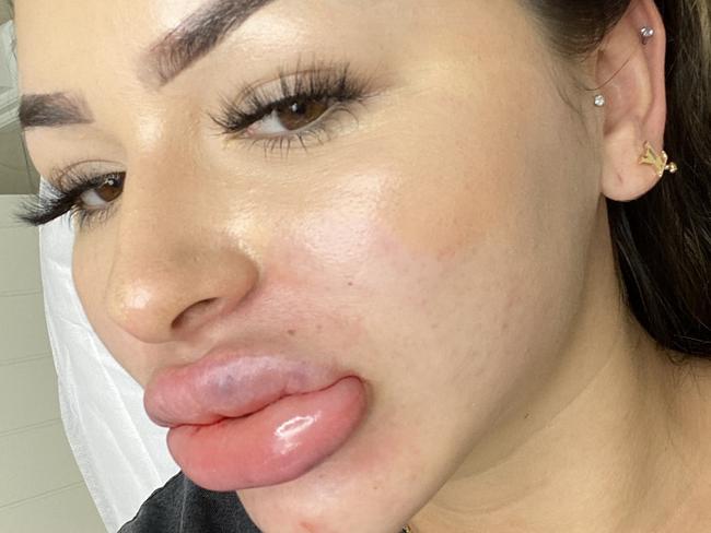 Anna Paul gets her lip fillers removed.