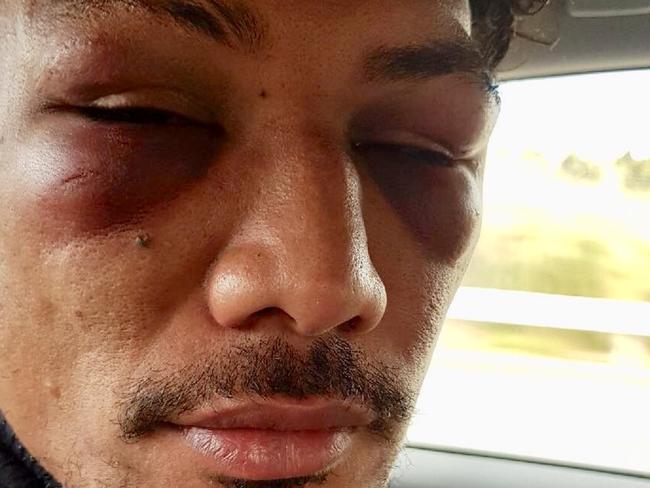 *** DT EXCLUSIVE. WARNING - FOR DT ONLY. NO ONLINE BEFORE CHECKING WITH DT PIC DESK ** The Melbourne Rebels’ Lopeti Timani the day after an altercation with Super Rugby teammate Amanaki Mafi in Dunedin, New Zealand. Picture: Supplied. Not to be used without permission of Adam Mobbs or Tim Morrissey