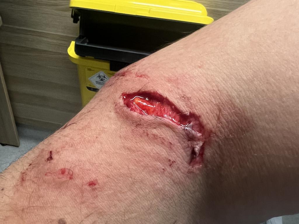 Graphic images of Tim Tszyu's dog bite injury