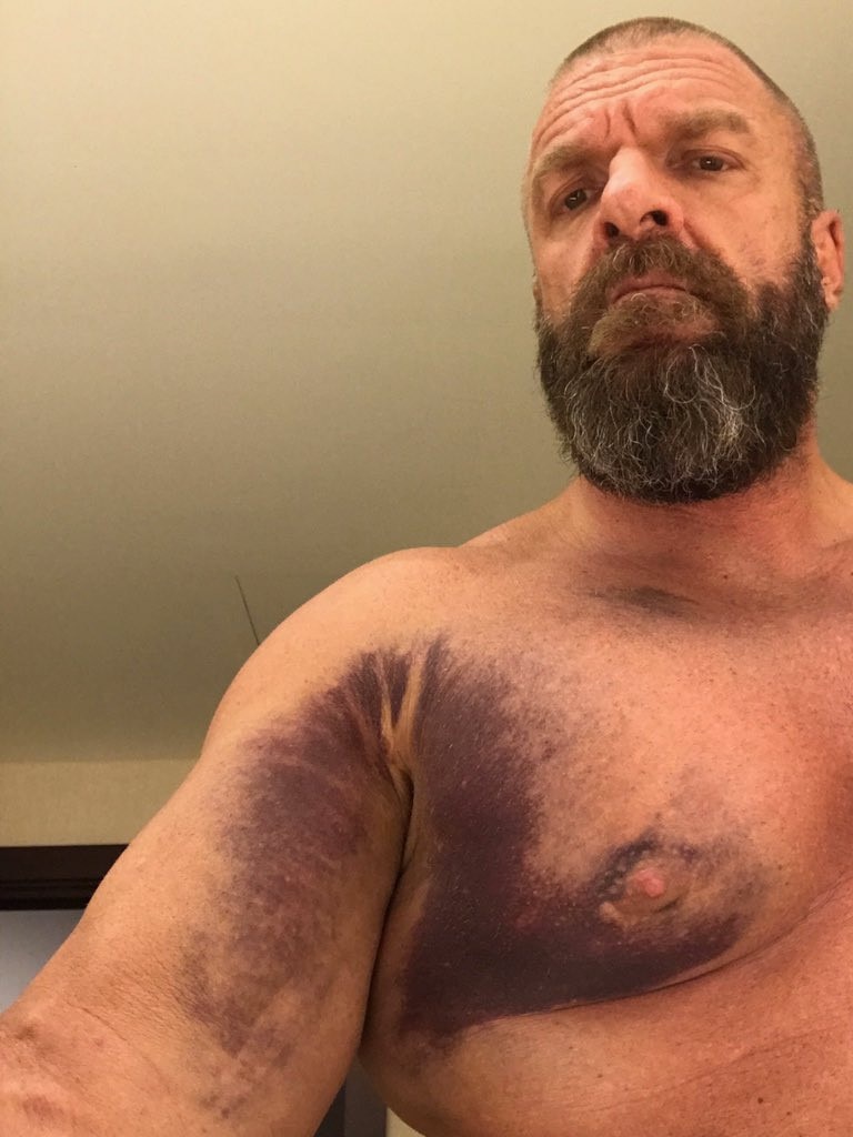 WWE legend Triple H posts graphic photo after tearing pectoral muscle at  Crown Jewel