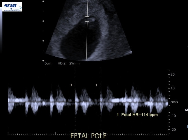 The heart rate of the fetal pole.