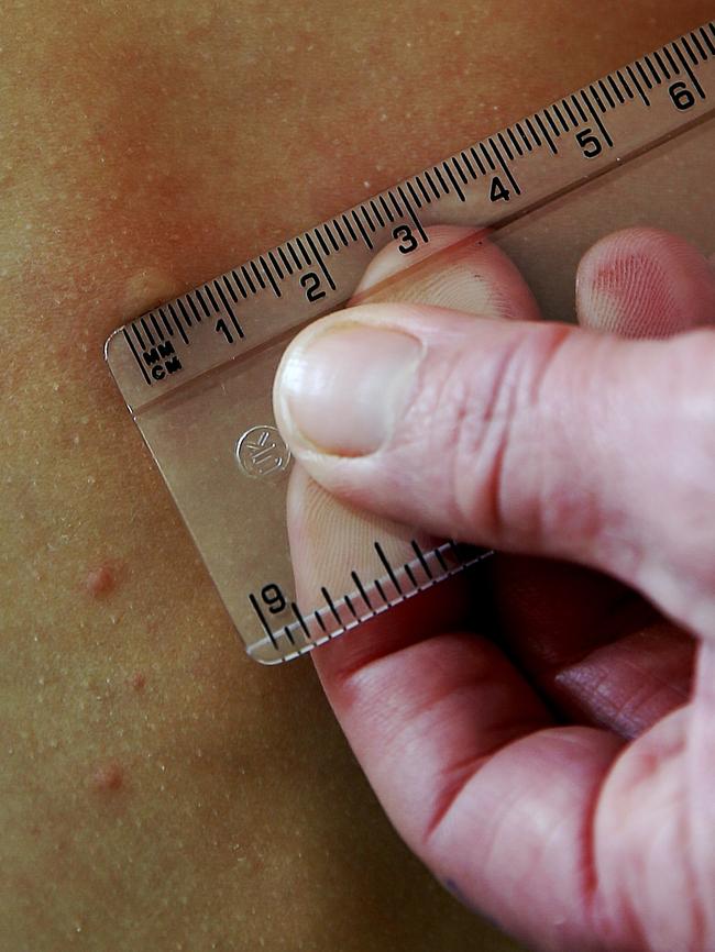 Hives are measured on Cooper’s back. Pictures Tim Carrafa