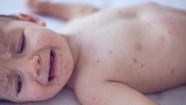 The measles case occurred in an infant who was too young to be fully vaccinated against the disease. Picture: iStock