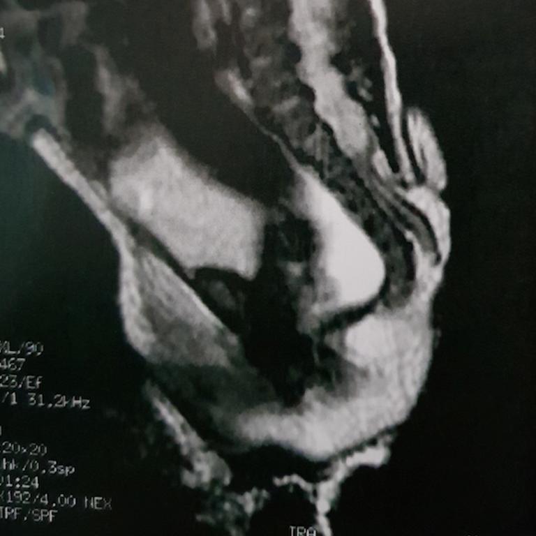 The tail generated up from the lumbosacral region, the area that connects the spine to the pelvis. Picture: Journal of Pediatric Surgery Case Reports