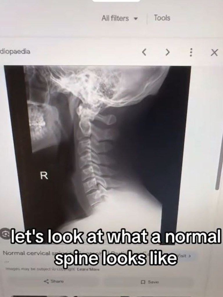 American chiropractor, Jake Boyle, said a ‘normal’ spine should show a slight backwards curve. Picture: @desmoineschiro/TikTok