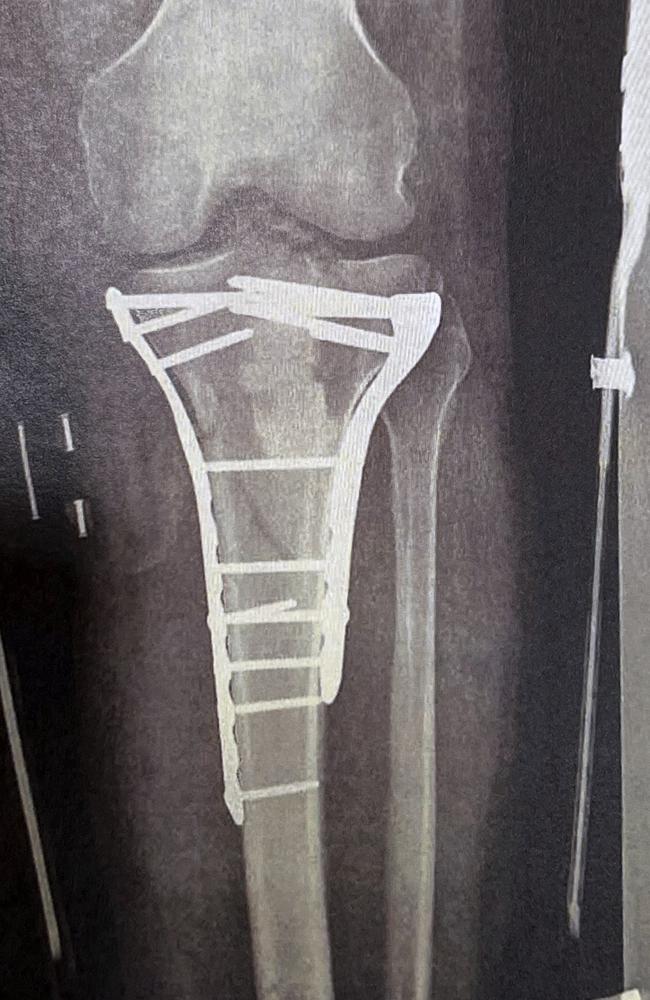 An x-ray of screws and plates inserted into John Bevan’s leg. Picture: Supplied