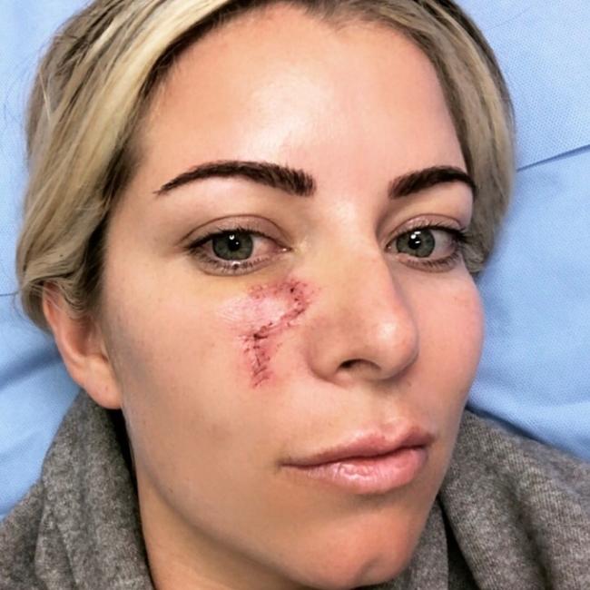 Ms Webster said surgery left her with a P-shaped scar. Picture: Supplied