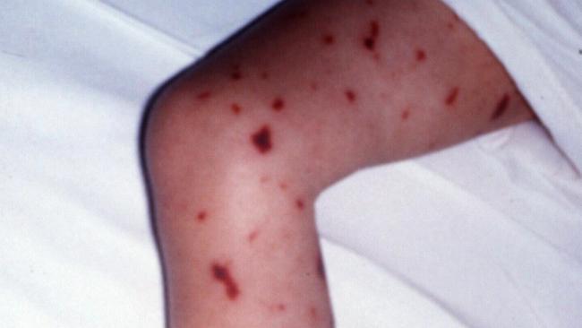 Meningococcal disease can sometimes cause a rash.