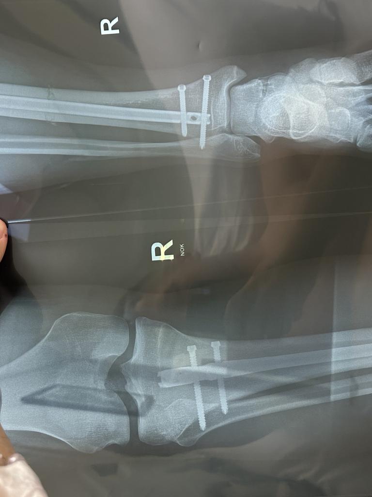 X-rays show the screws now in Ilias’ leg after breaking his tibia.