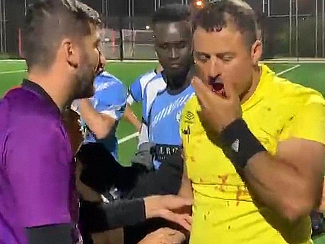 Khoder Yaghi grabs at his jaw after being bashed at a Bankstown District Amateur Football match. Picture: Supplied<a href="/truecrimeaustralia/police-courts-nsw/sydney-soccer-referees-jaw-broken-after-vicious-player-attack-at-padstow-match/news-story/88c42a7eb5253af03d6dfbf593eca92c" target="_blank"></a>