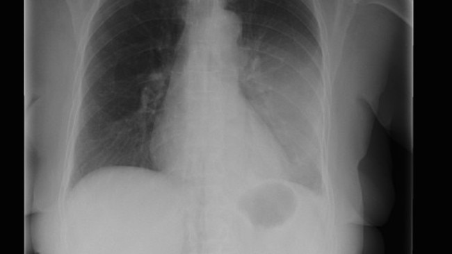 An x-ray of a lung affected by pneumonia.