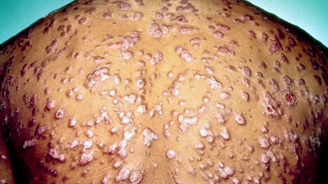 Reddish papules and nodules over much of the body caused by secondary syphilis. Picture: Supplied