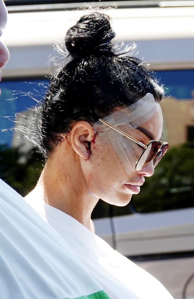 Katie Price has been pictured with her son Harvey as she's seen for the first time with a heavily bandaged and bruised face. Picture: Backgrid.