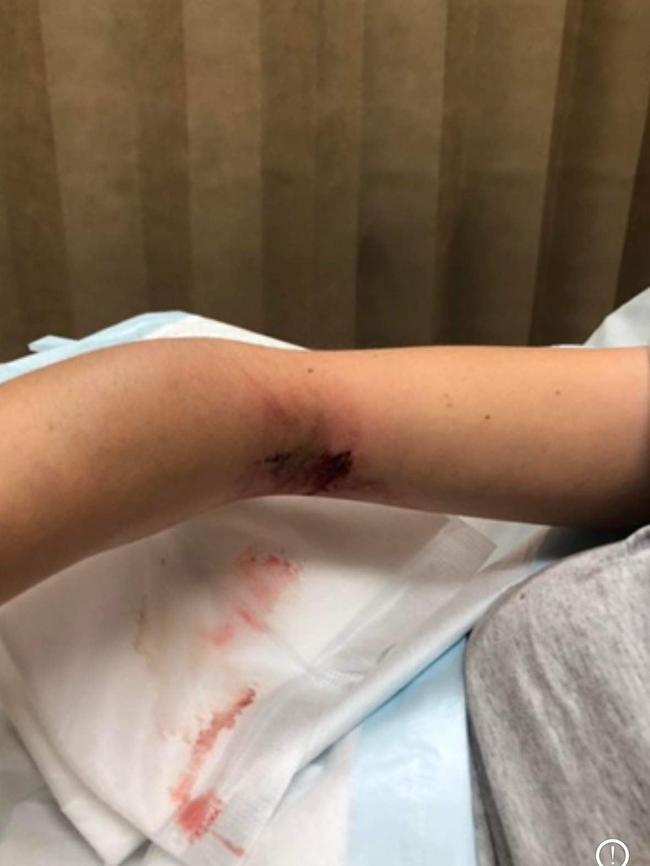 Her arm, swollen and injured after the accident. Picture: Supplied