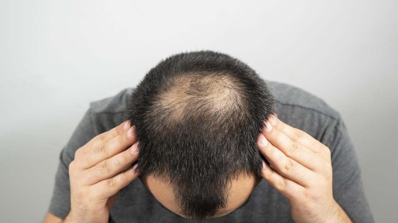 12 tips for solving male hair loss  — Australia's leading news  site