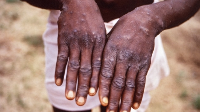 Symptoms of monkeypox include a distinctive bumpy rash, skin lesions, fever and body aches.