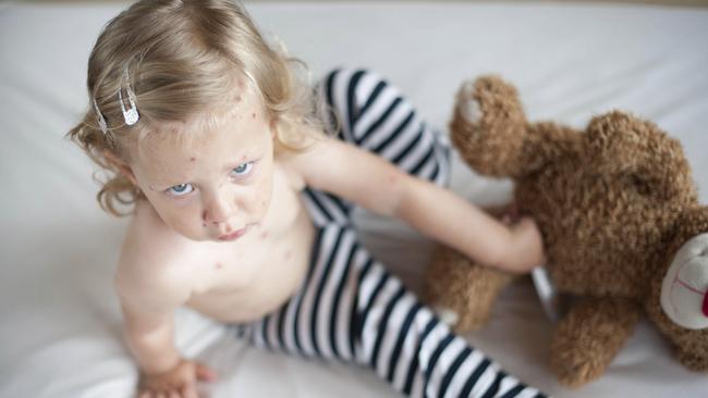 The new age parties are a twist on Pox Parties, where parents deliberately expose their children to infectious diseases like chickenpox. Picture: supplied