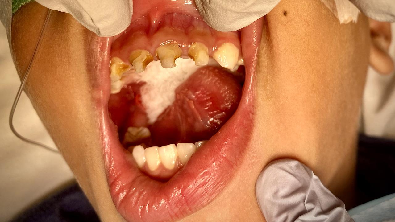 An unidentified young oral health patient from Far North Queensland who recently required surgery due to tooth decay. Picture: Supplied