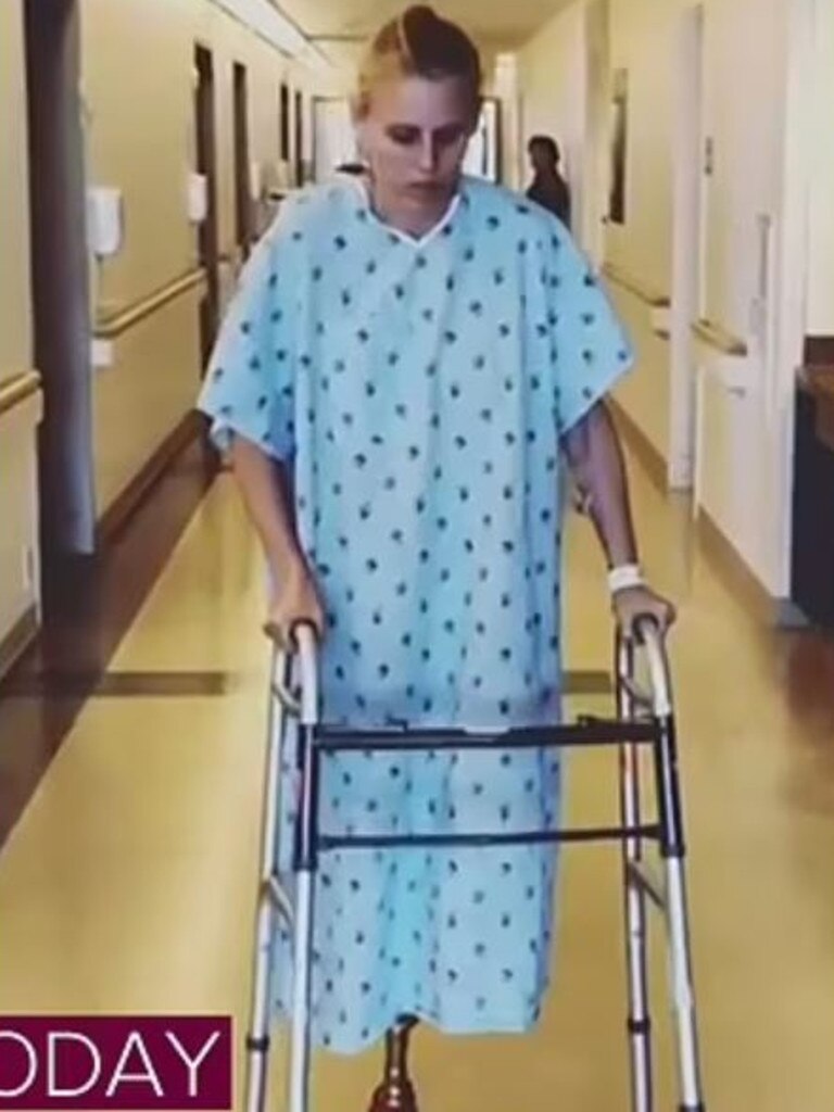 She had to learn to walk properly again after the amputation. Picture: Instagram / @theimpossiblemuse