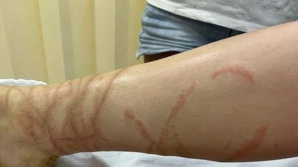 A teenage girl was stung by a deadly Box Jellyfish at Airlie Beach on December 30.