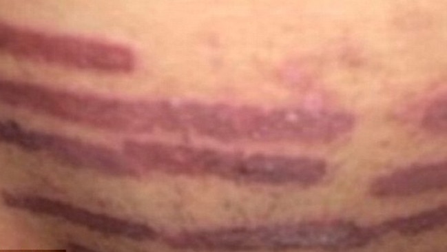 The woman was left with a number of burns on her crotch. Picture: Helen Golisano