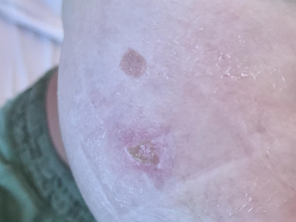 When she was admitted to hospital, Danielle had an oozing sore on her right breast that was treated with IV antibiotics. Pictured is it healing. Picture: Supplied via NCA NewsWire