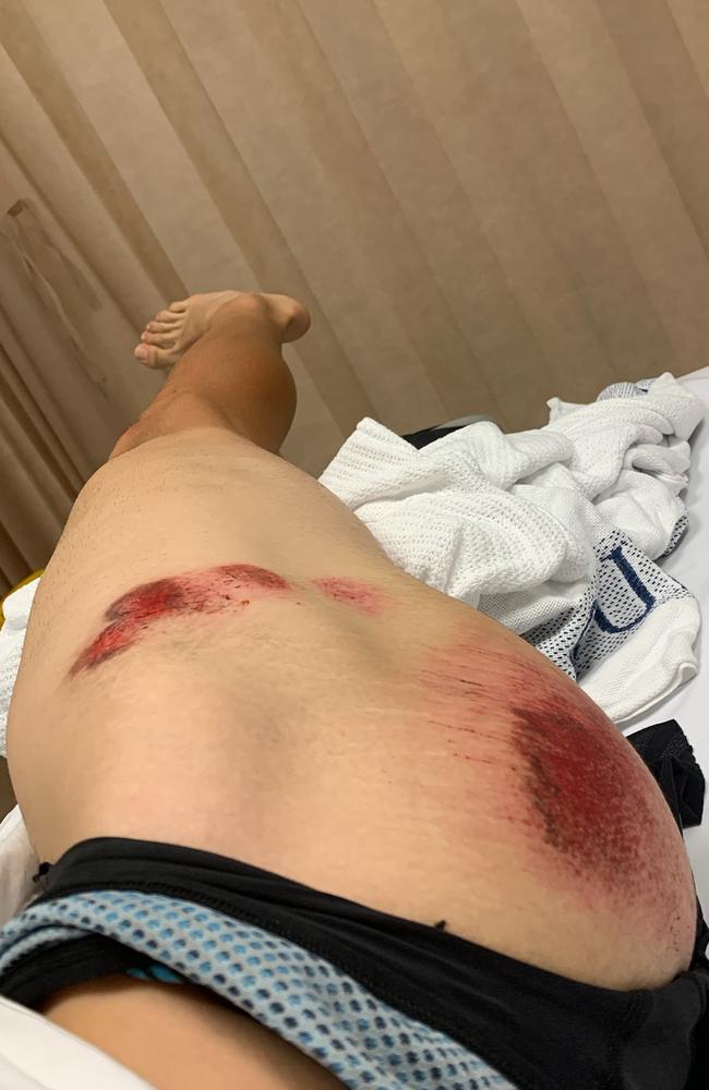 Australian Cycling Academy rider Daniel Di Domenico, 20, sustained a head injury and gravel rash after an alleged hit and run incident. Picture: Contributed