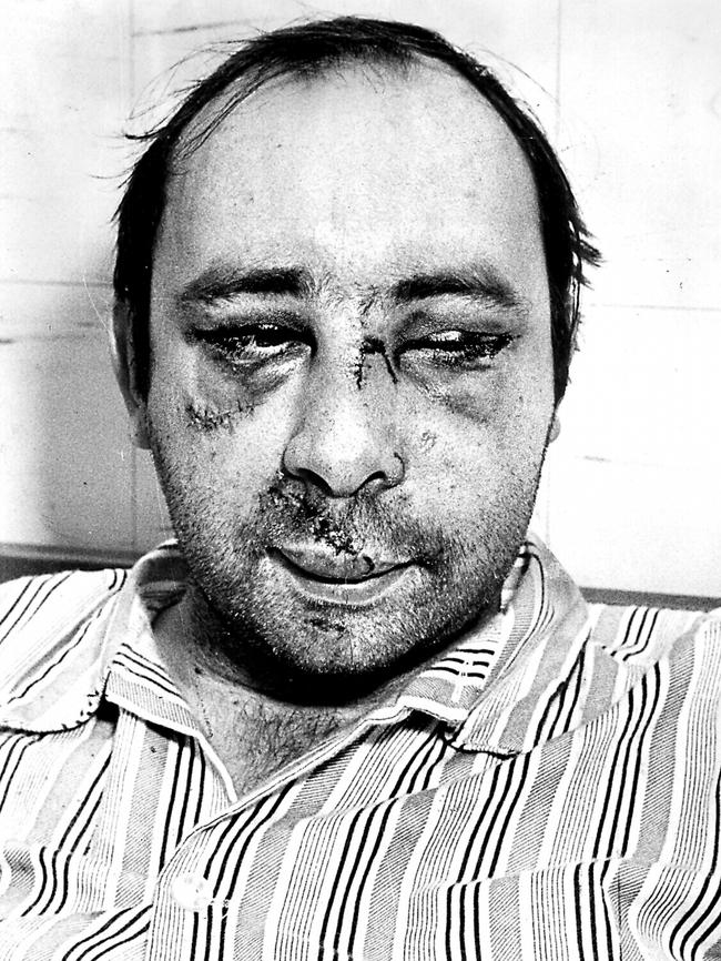 Labor MP Peter Baldwin in Royal Prince Alfred Hospital in Sydney after he was bashed at his Marrickville home. File picture